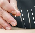 dry needling